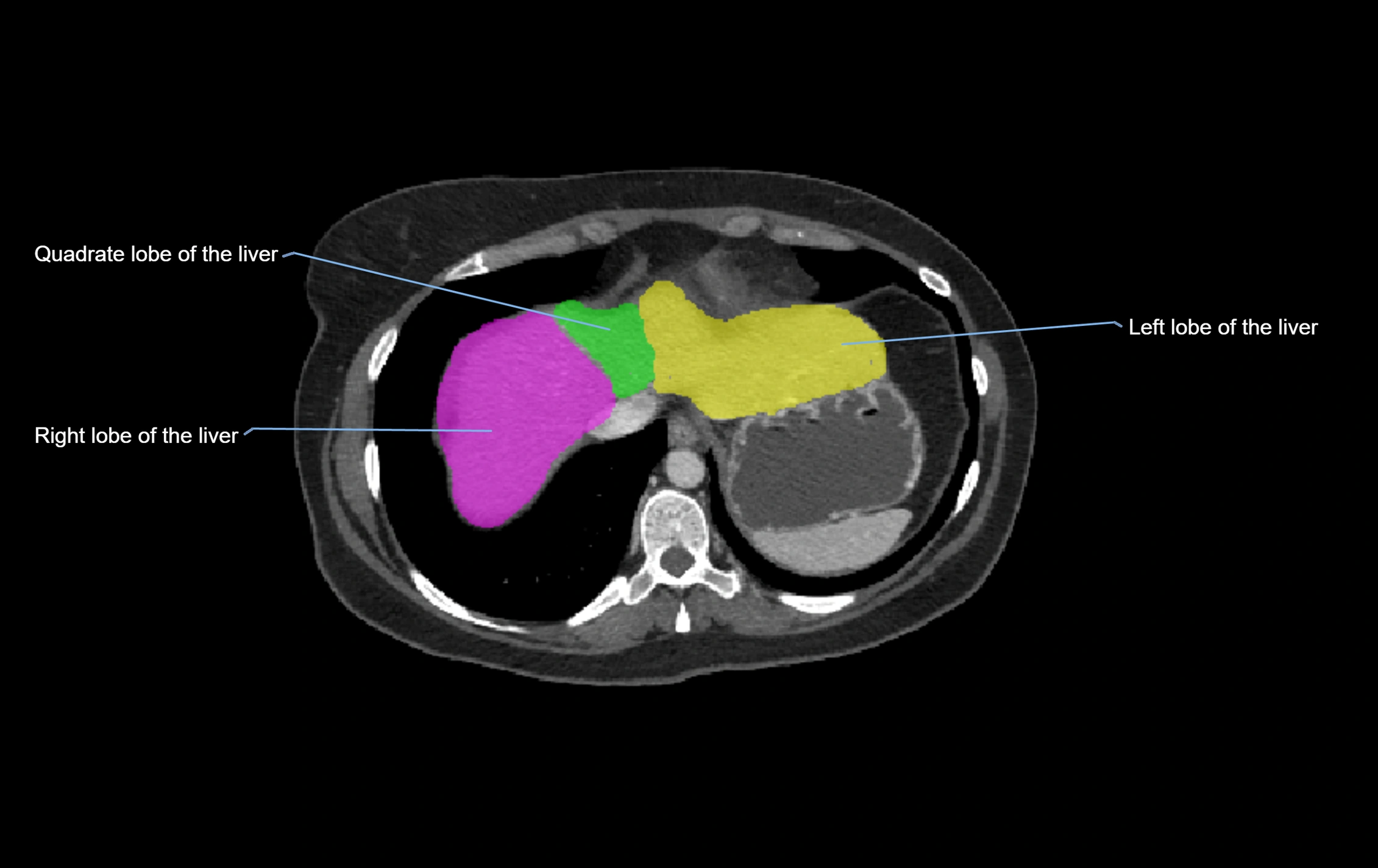 CT lliver lobes axial cross sectional anatomy labelled image -00070.webp